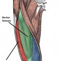 Fig 1.1. The vastus muscles of the thigh. The vastus intermedialis lies deep to the other muscles, and is not visible