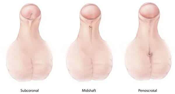 Types Of Penis Heads 94