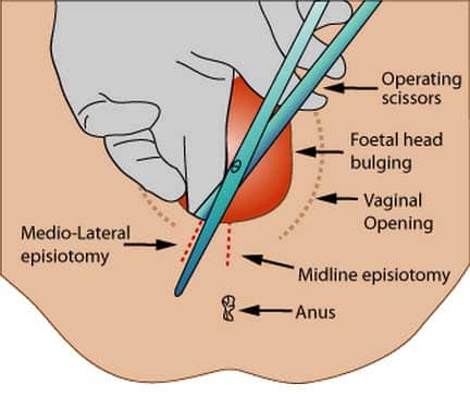 Vaginal flatulence - Wikipedia