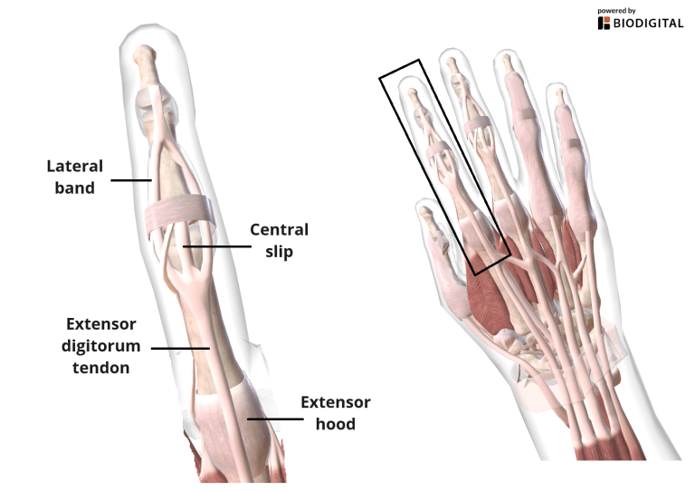 Extensor Tendon Injury Of The Distal Interphalangeal Joint – XHUIKU