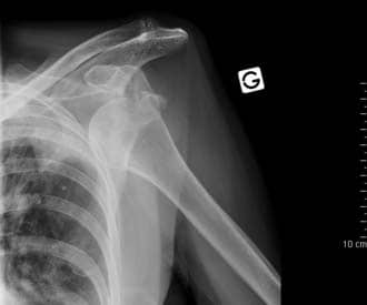 Fig 1.4 - Anterior dislocation of the shoulder joint.