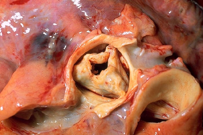Fig 4 - Aortic stenosis, secondary to rheumatic heart disease. The aorta has been removed to show thickened, fused aortic valve leaflets and opened coronary arteries from above.