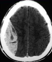 Fig 1.1 - CT scan of a massive extradural haematoma