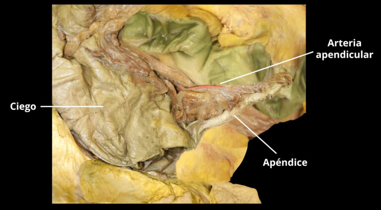 El apéndice - Retrocecal - Irrigación arterial - Apendicitis ...