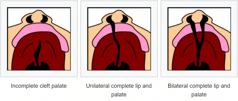 Development of the Face - Nose - Palate - Cleft Lip - TeachMeAnatomy