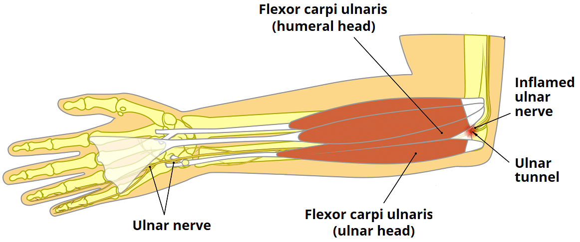 Medical illustration to explain Cubital tunnel syndrome. Ulnar nerve  entrapment. Fascia involved in ulnar nerve compression. Stock Illustration