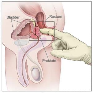 Fig 5 - Digital rectal examination of the prostate in males.