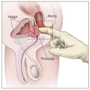 Fig. 5: Tacto rectal de la próstata en hombres.