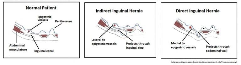 Inguinal Hesselbach S Triangle Borders Direct Hernia Teachmeanatomy