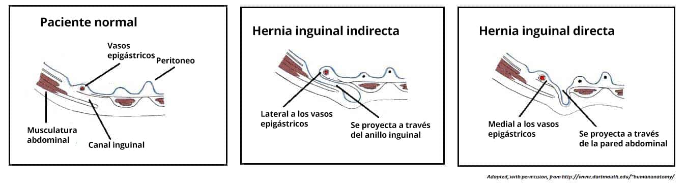 Plano transversal en el que se compara la anatomía abdominal normal con una hernia inguinal indirecta y directa.