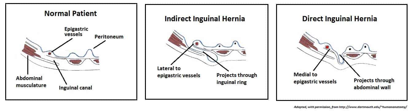 Inguinal Hernias Direct And Indirect Inguinal Hernias Inguinal Hernias Direct And Indirect Inguinal Hernias