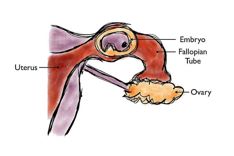 Fig 1.4 - Ectopic pregnancy.