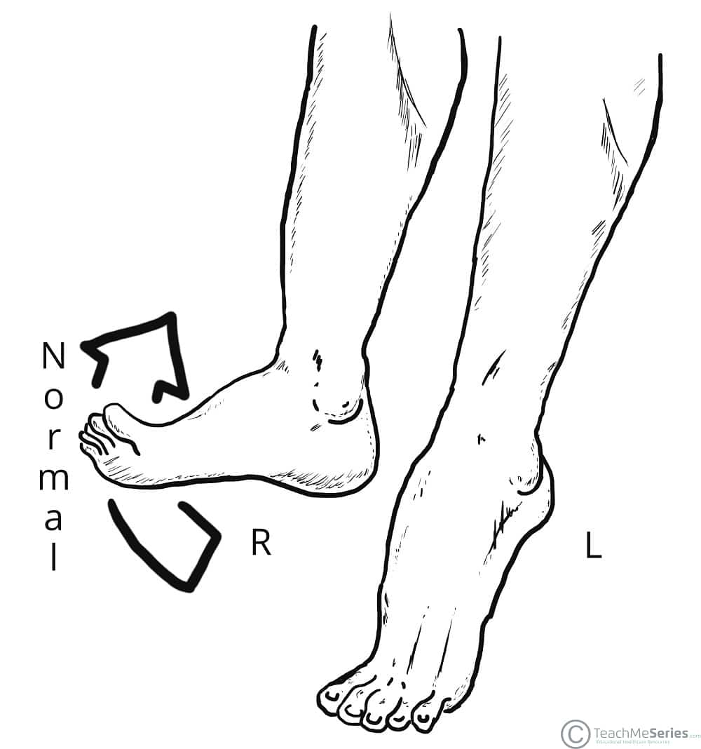 Foot Drop Common Fibular Nerve Palsy