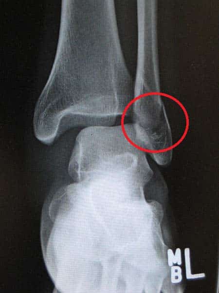 Fig 1.1 - Fracture of the lateral malleolus.