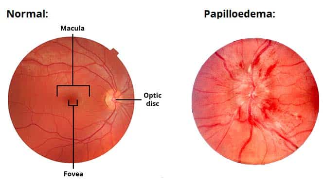 Fig 1.4 - The fundus (interior surface) of the eye.