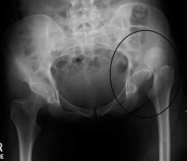 Fig 4 - Radiograph showing an anterior dislocation of the hip joint. 