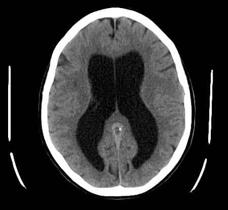 The Ventricles Of The Brain Lateral Third Fourth TeachMeAnatomy