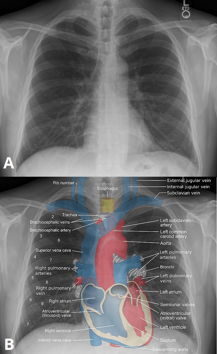 Double line sign, Radiology Reference Article