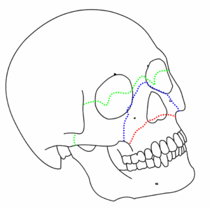 Diagram illustrating the Le Fort classification of maxillary fractures, featuring three types: Type I (red) - horizontal fracture of the maxilla; Type II (blue) - pyramidal fracture involving the nasal bridge and adjacent structures; Type III (green) - craniofacial separation from the skull base.
