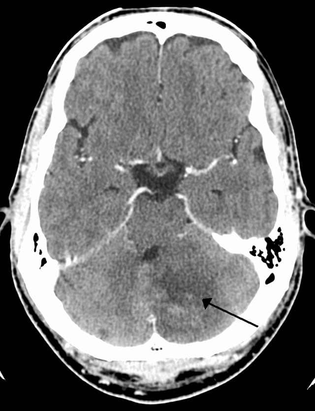 Fig 1.4 - CT scan of a left sided cerebellar stroke.
