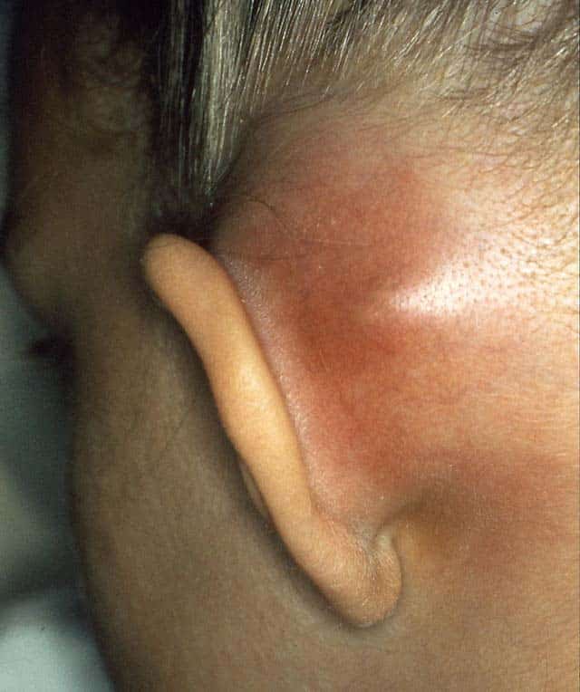 Fig 1.3 - Mastoiditis - infection of the mastiod air cells, causing local inflammation