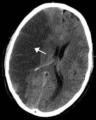 Fig 1.4 - CT scan of the brain, showing an infarct in the area of the middle cerebral artery.
