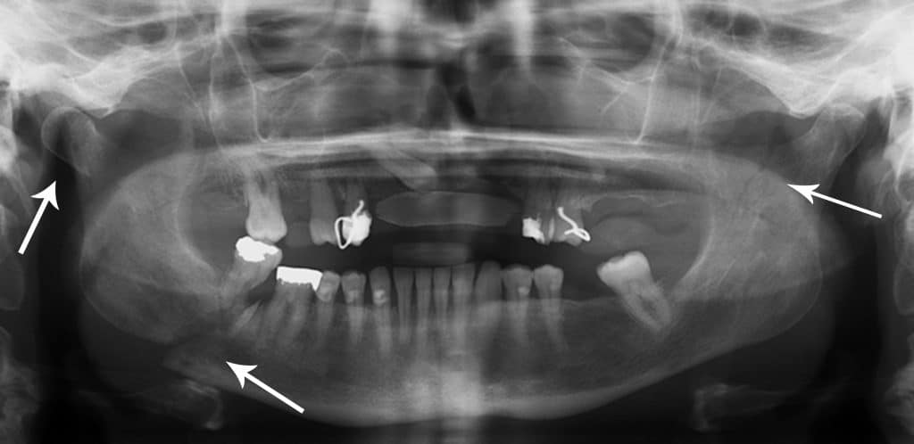 Fig 4 - Multiple mandibular fractures (marked by arrows). This illustrates that fractures of the mandible rarely occur in isolation.