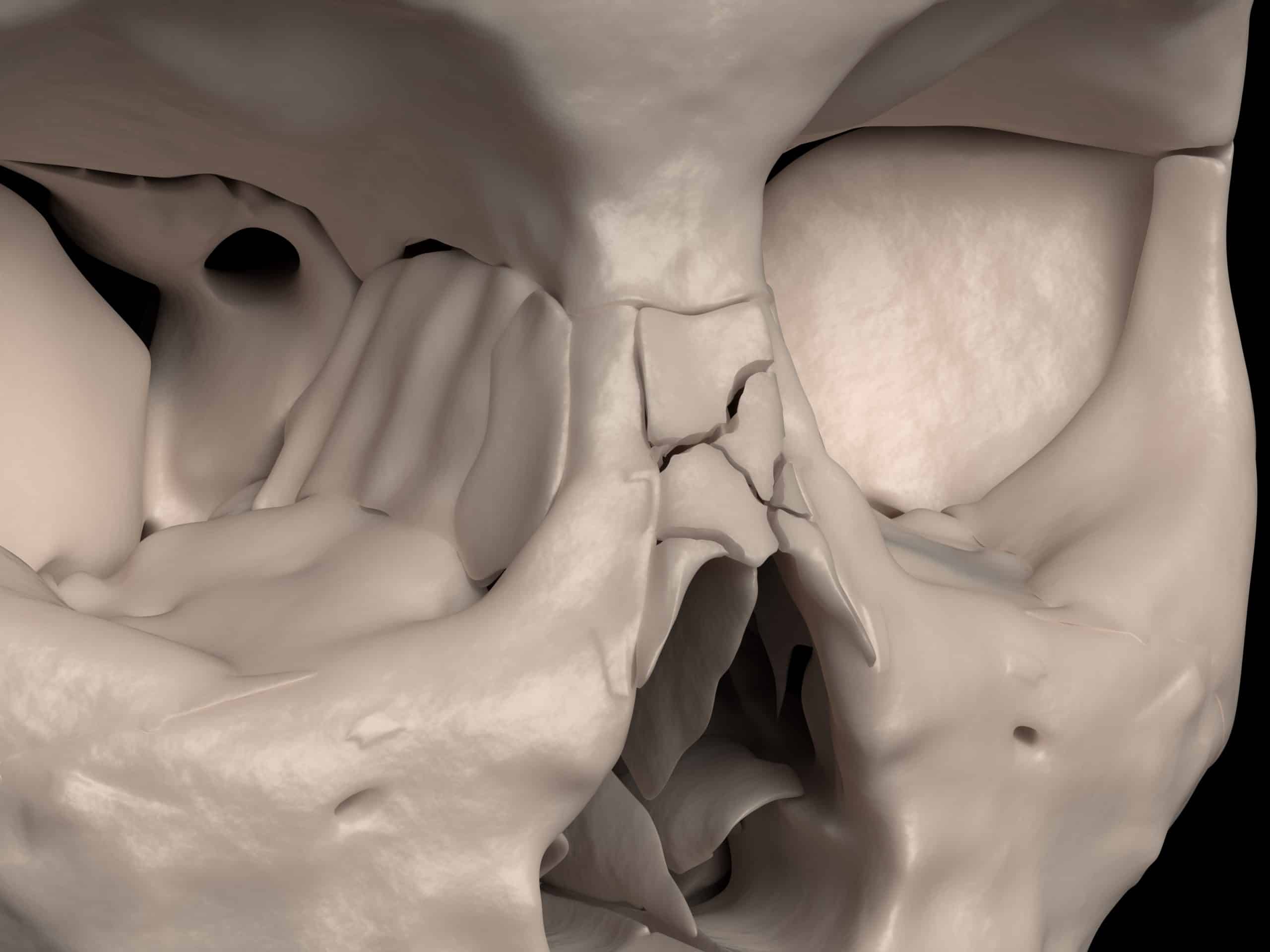 Bones of the Skull - Structure - Fractures - TeachMeAnatomy