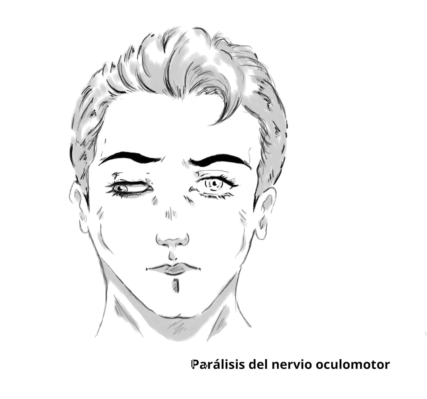 Parálisis del nervio oculomotor derecho, que se manifiesta mediante una pupila dilatada con desplazamiento hacia abajo y hacia fuera y ptosis ipsilateral.