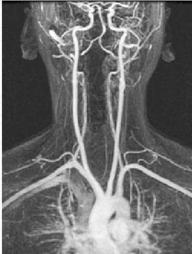 Arterial Supply To The Brain Carotid Vertebral Teachmeanatomy