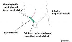 Diagram illustrating the anatomical location of the inguinal canal, highlighting its position lateral to the inferior epigastric artery.
