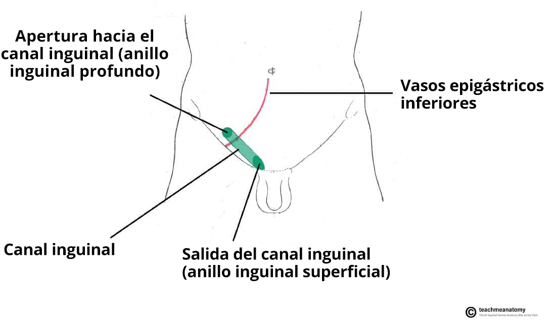 Diagrama que ilustra la posición anatómica del canal inguinal, destacando su posición lateral respecto a la arteria epigástrica inferior.