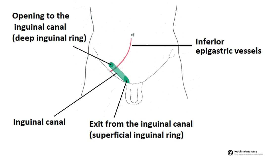 Fig 1.0 - Overview of the inguinal canal. Clinically it is important to note that the opening to the inguinal canal is located laterally to the inferior epigastric artery