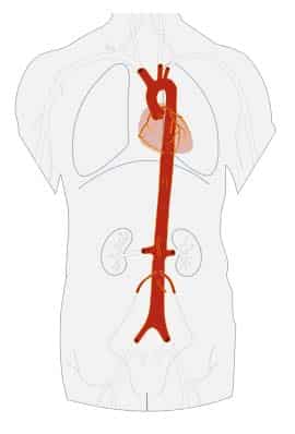 Fig 1.0 - Overview of the anatomical course of the aorta. By Edoarado [CC BY-SA 3.0], via Wikimedia Commons