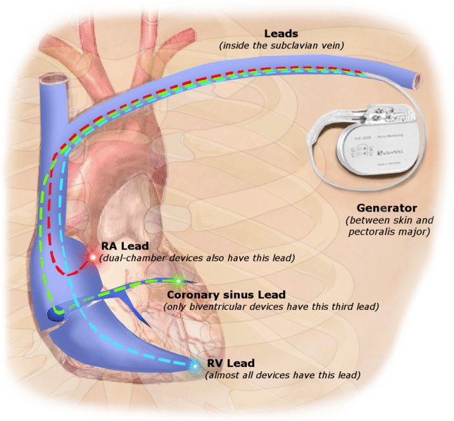 Can Your Heart Skip A Beat With A Pacemaker Conducting System Of The Heart Bundle Of His Sa Node Teachmeanatomy