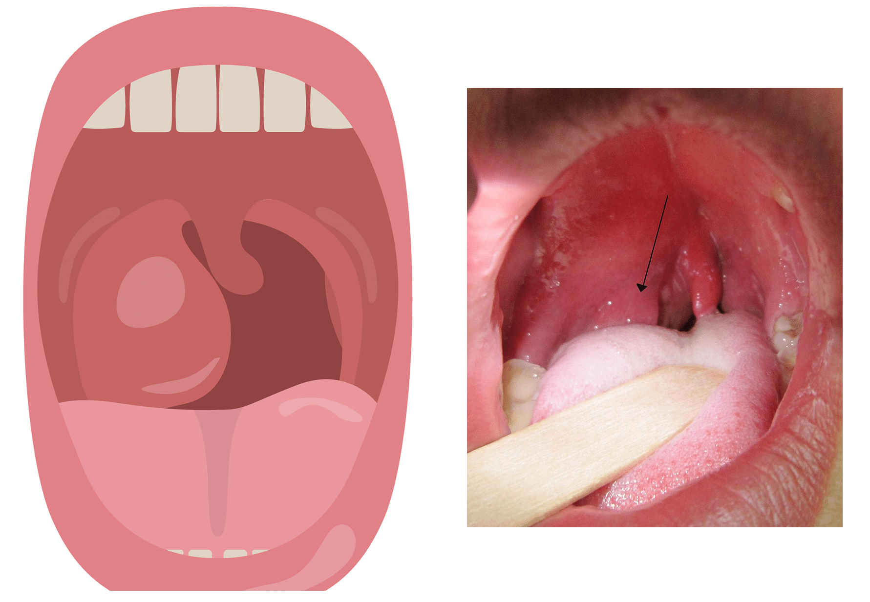 Waldeyer's Tonsillar Ring - an overview | ScienceDirect Topics