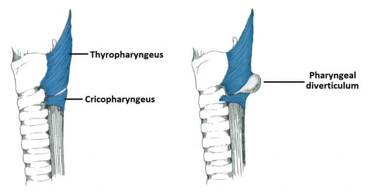 deglutination inferior pharyngeal constrictor