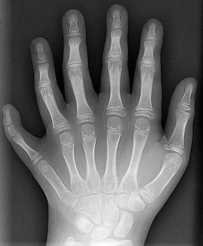 Fig 2 An example of polydactyly on x-ray. This patient had a duplication of their middle finger.