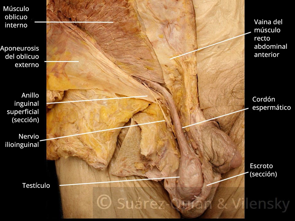 Prosection of the superficial inguinal ring and contents of the inguinal canal.