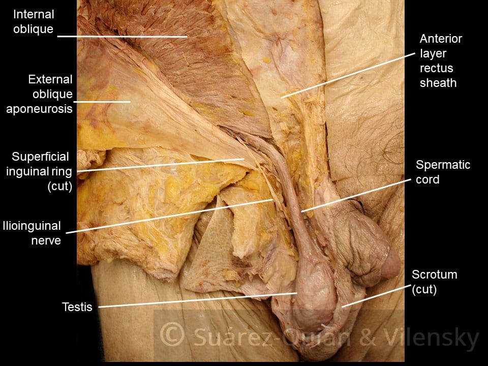 Leiden - Drawing Inguinal canal: continuation of abdominal wall in  funiculus - English labels | AnatomyTOOL