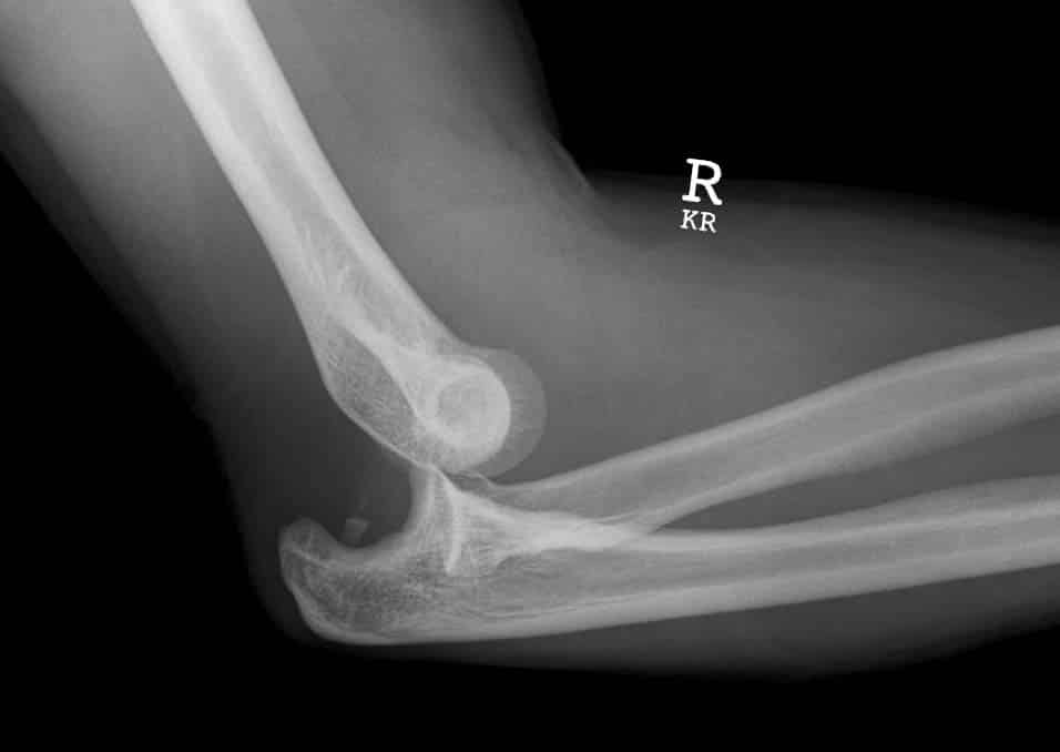 Fig 1.2 - X-ray of a posterior dislocation of the elbow.