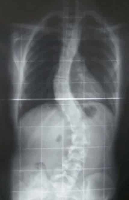 Fig 1.5 - Radiograph of scoliosis of the spine.