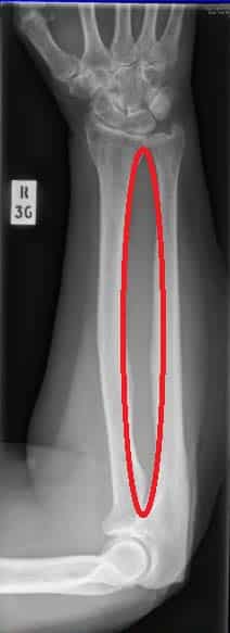 Fig 1.3 - The ring structure of the forearm bones.