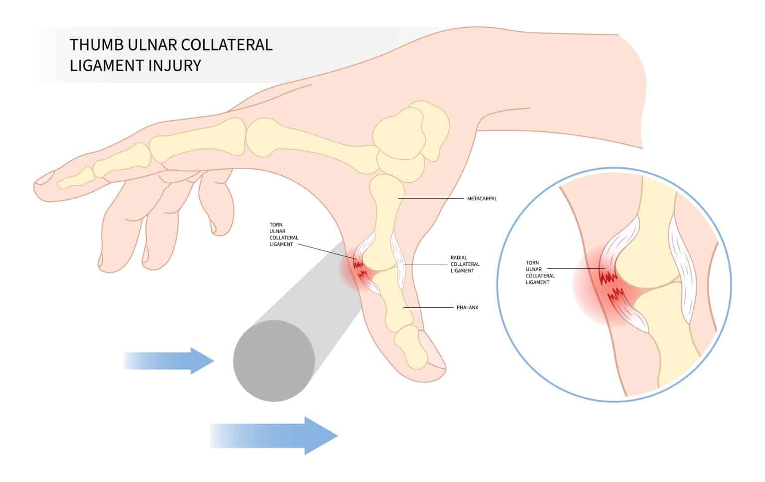 The Metacarpophalangeal Joint Ligaments TeachMeAnatomy