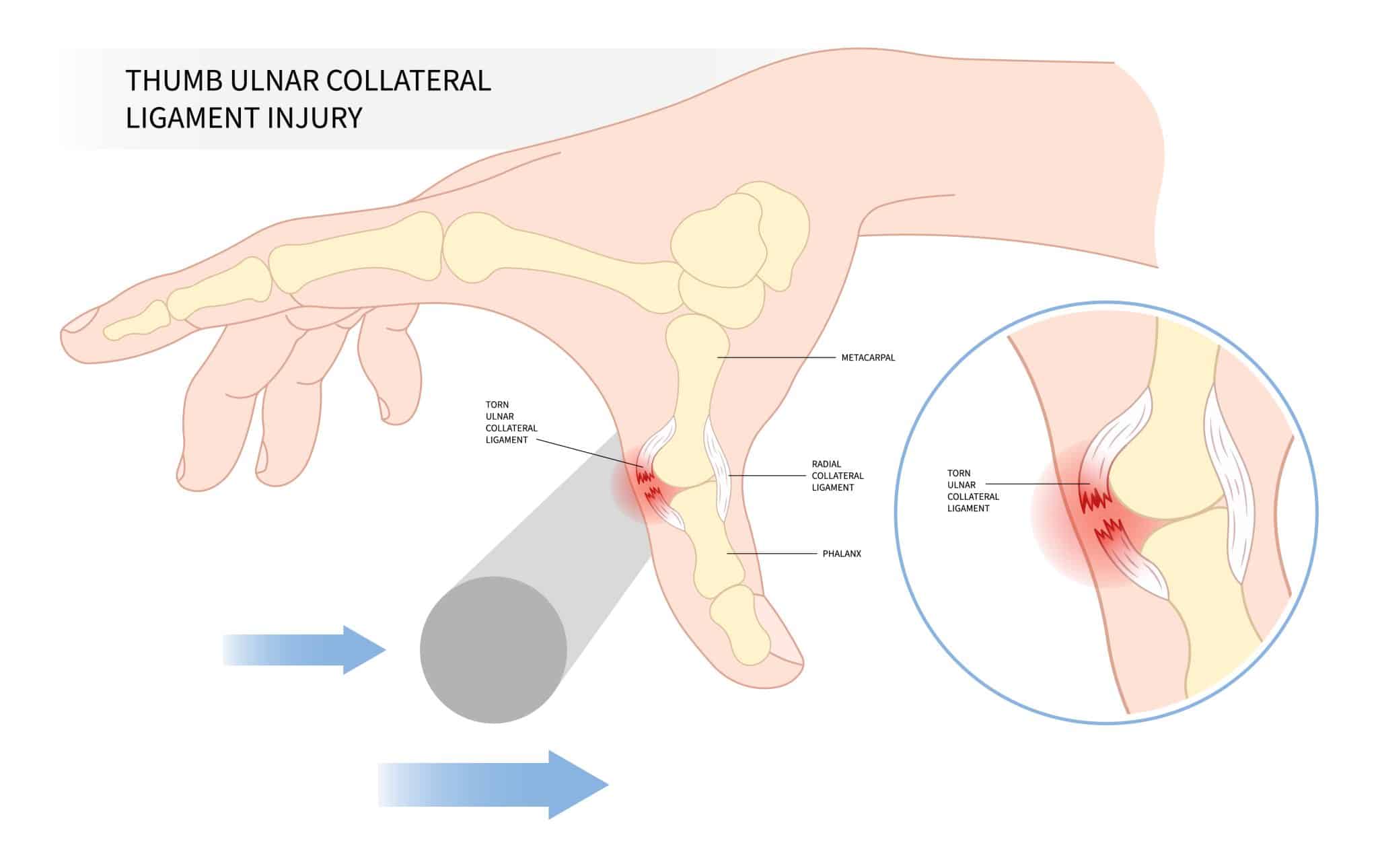 The Metacarpophalangeal Joint Ligaments TeachMeAnatomy
