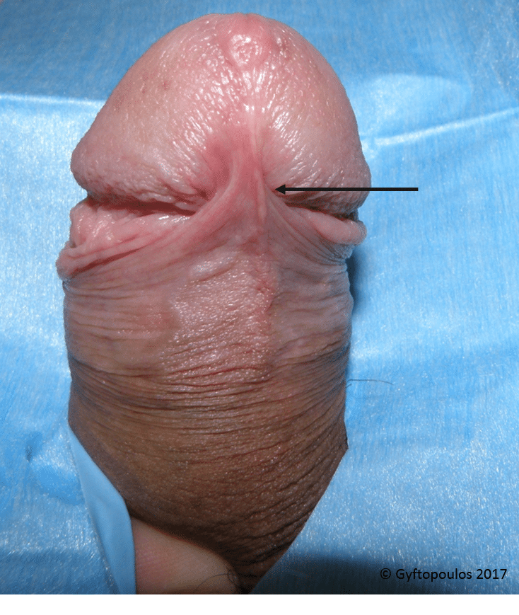 Note the skin fold of the frenulum (arrow). 