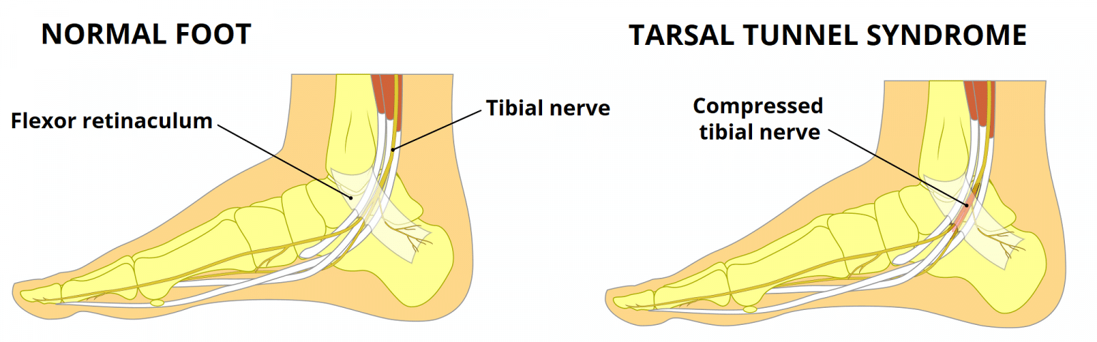 The Tarsal Tunnel Borders Contents Compression Teachmeanatomy 4640