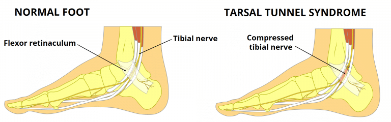 The Tarsal Tunnel Borders Contents Compression Teachmeanatomy