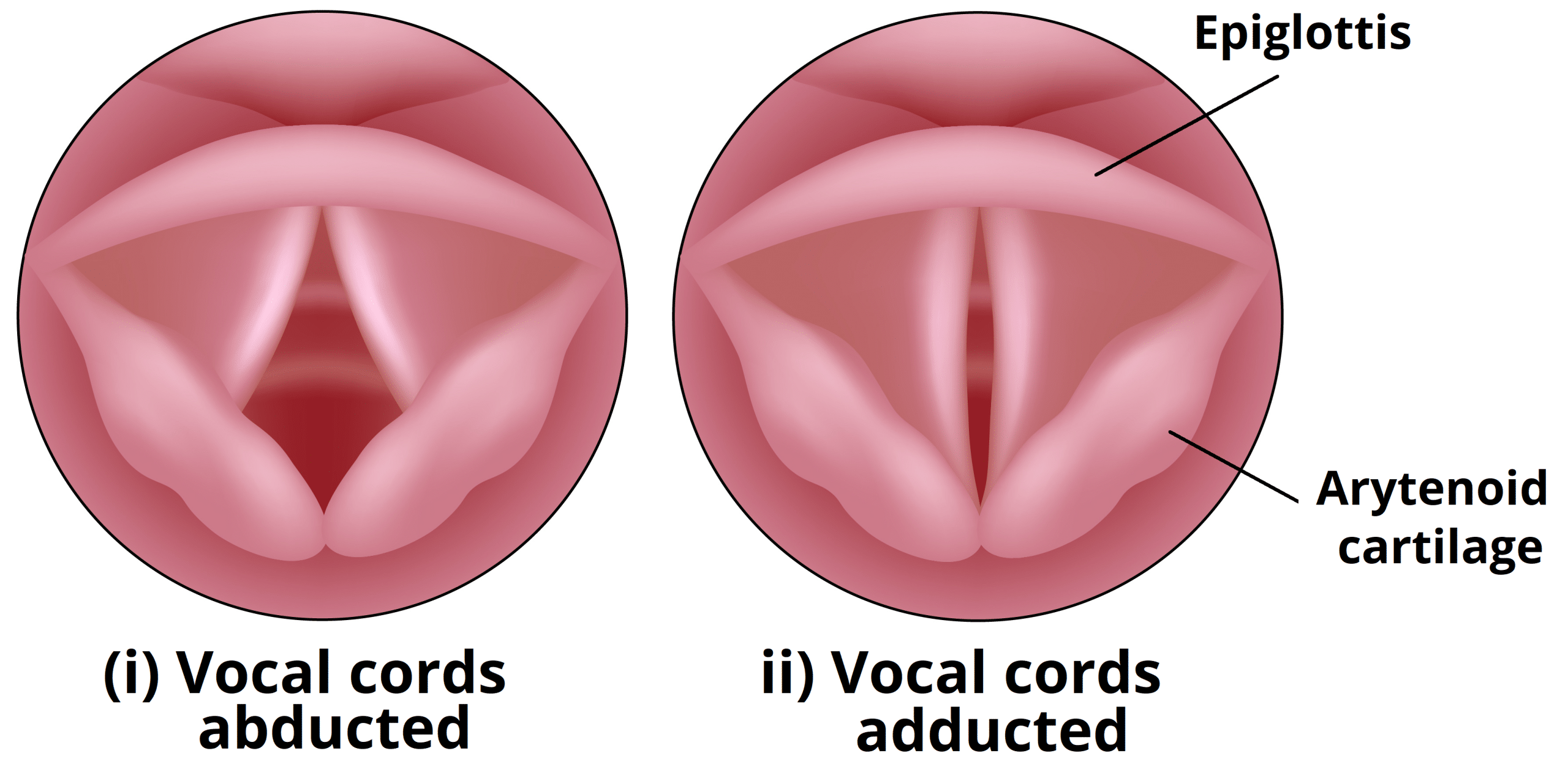 bilateral vocal cord paralysis