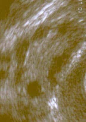 Fig 1.2 - Ultrasound image of a polycystic ovary